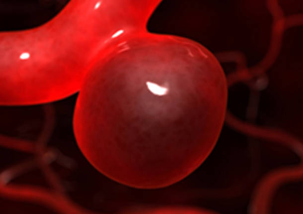 ecografia addominale e aneurisma aorta